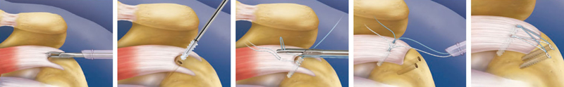 Rotatorenmanschettenruptur (Riss der Muskel-Sehnenplatte) Operation 